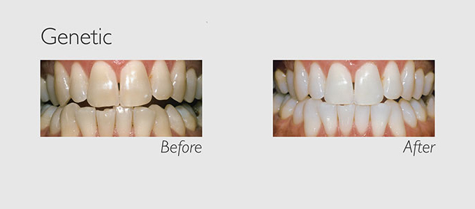 genetic teeth before and after teeth whitening 