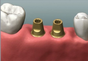 300_Dentist Perth Implant Abutment