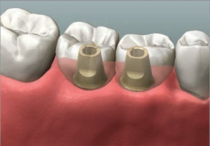300_Dentist Perth Implant Crown