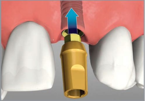 600_Dentist Perth Implant Screw