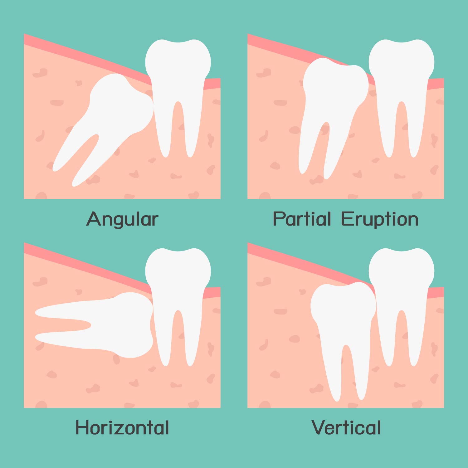 Tooth extraction Information