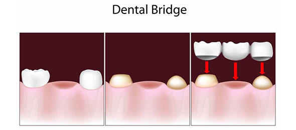 bridge illustration