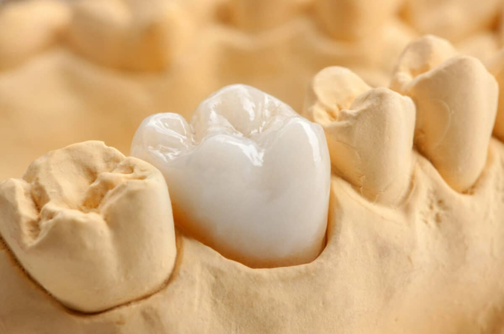 Dental Crowns - What Are They?