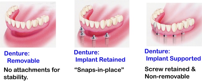 Diagram comparing a conventional denture, an implant‑retained denture and a fixed implant‑supported denture.