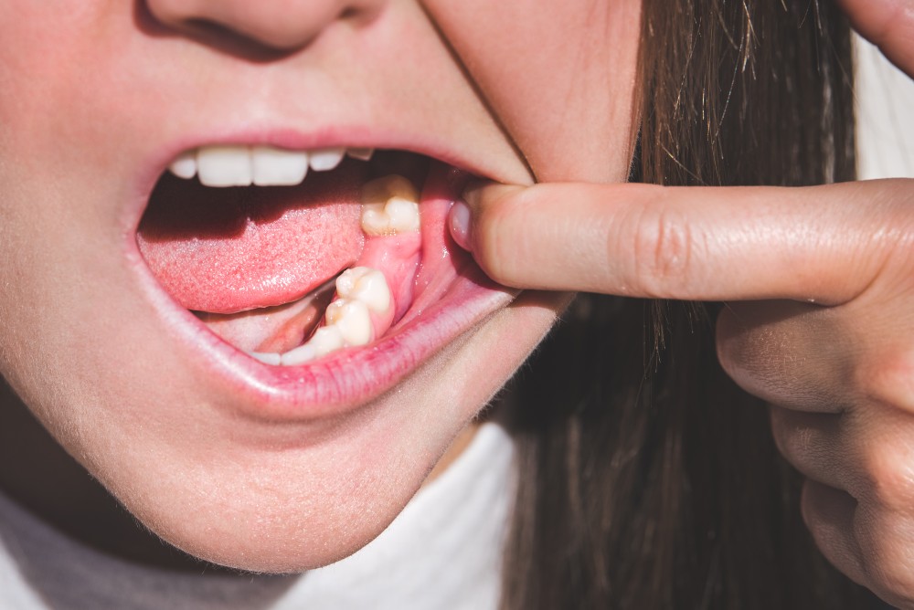 Woman with missing tooth