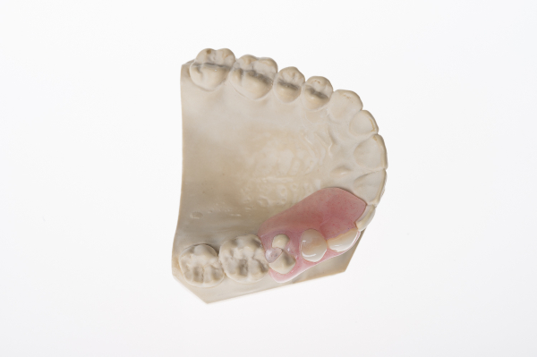 Ezifit Single Tooth Denture Overview