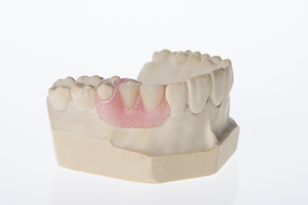 1 Tooth Partial Denture  