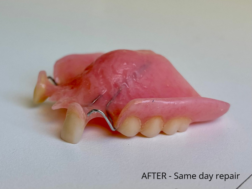 After - Same Day Repair of Partial Denture