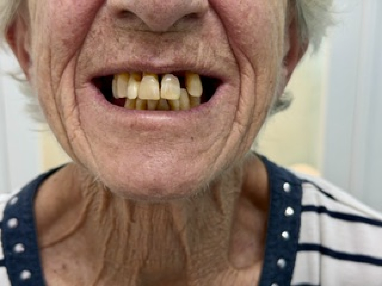 Image of mouth before extractions and insertion of immediate partial denture