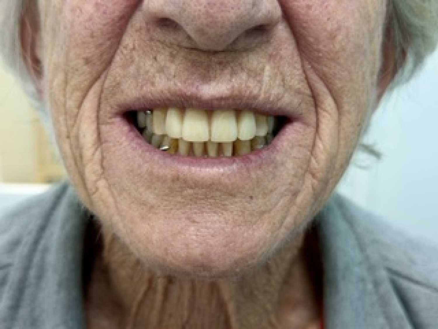 Image of immediate partial dentures