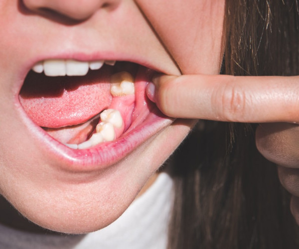 How much do dentures cost with extractions in 2024?.