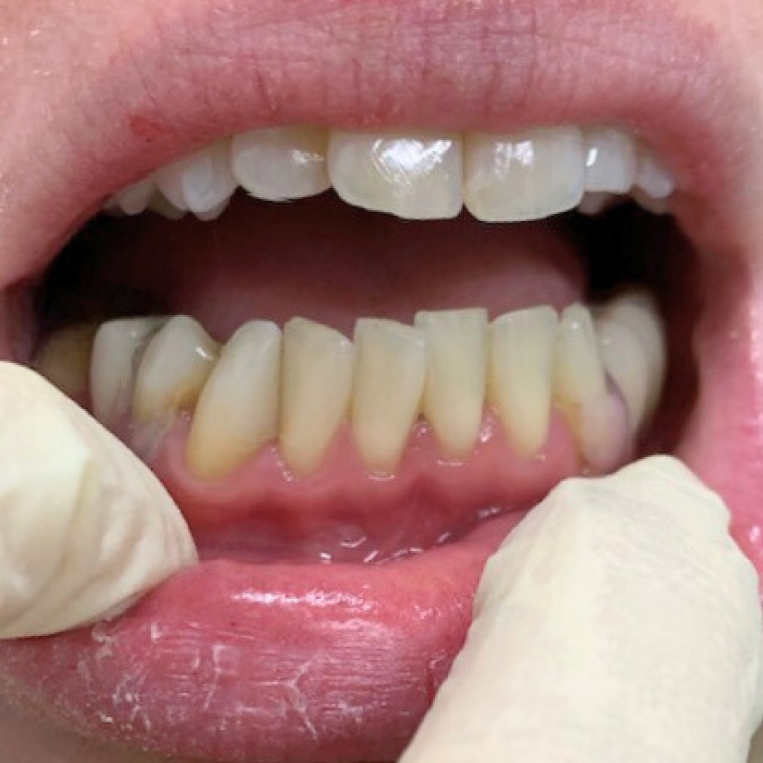Gum coloured clasps in mouth