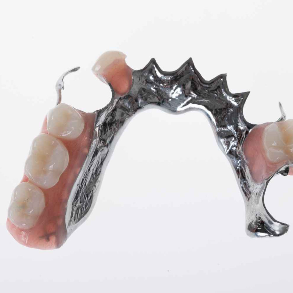 Partial chrome denture