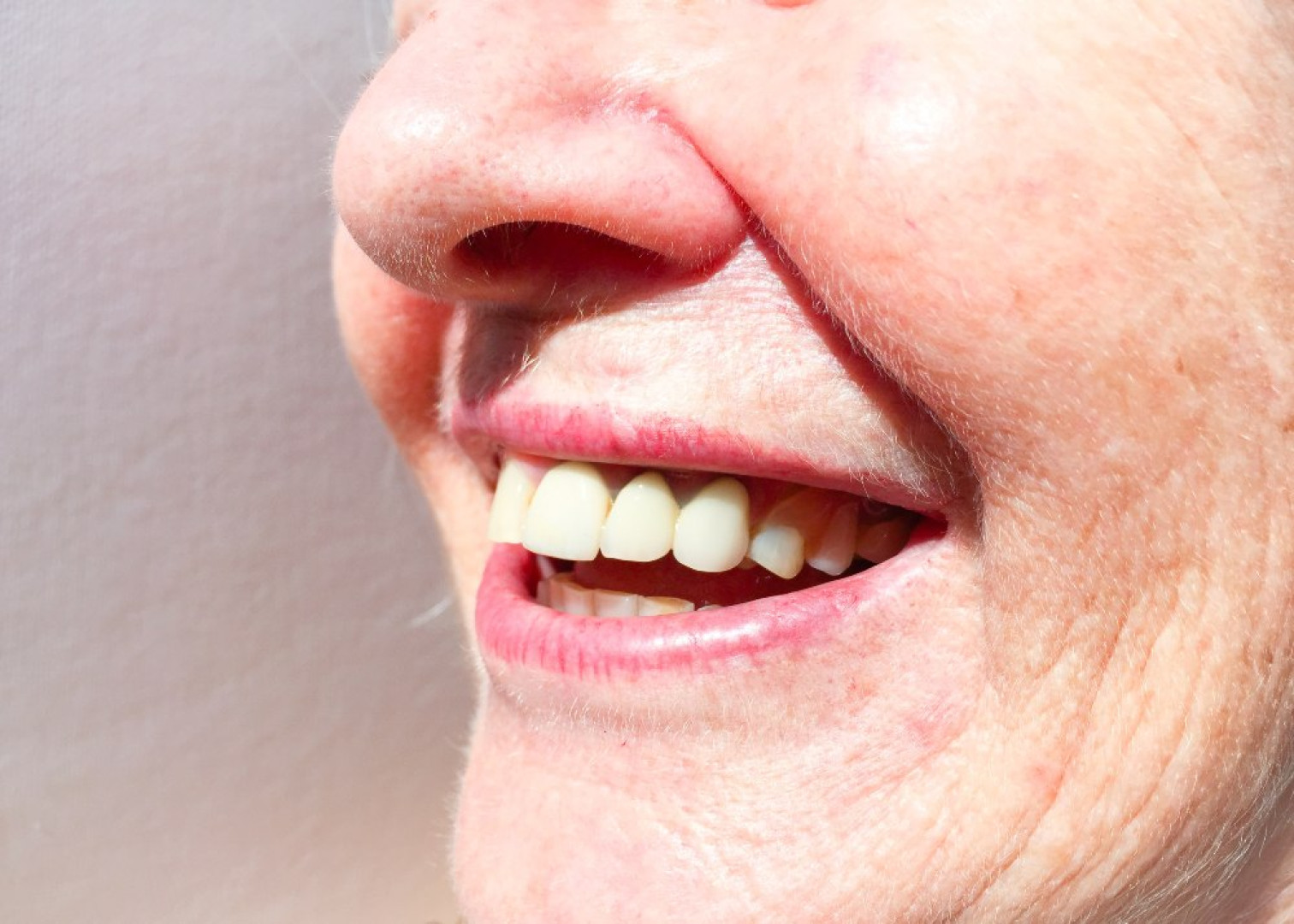 Single Tooth Denture | One Tooth Denture Solution