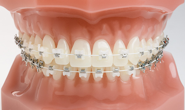 Ceramic braces