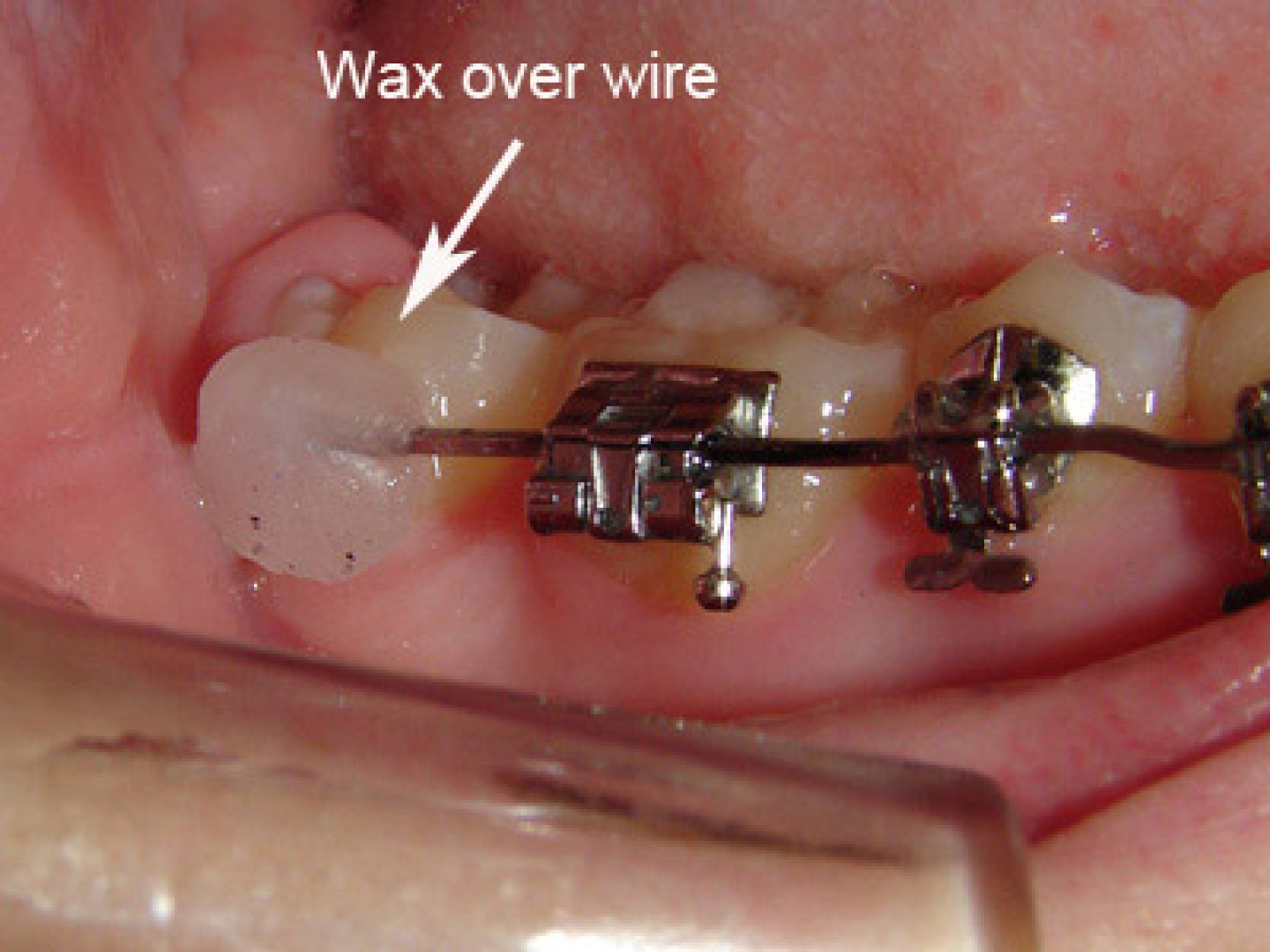 What to do when I have an orthodontic wire sticking out and poking