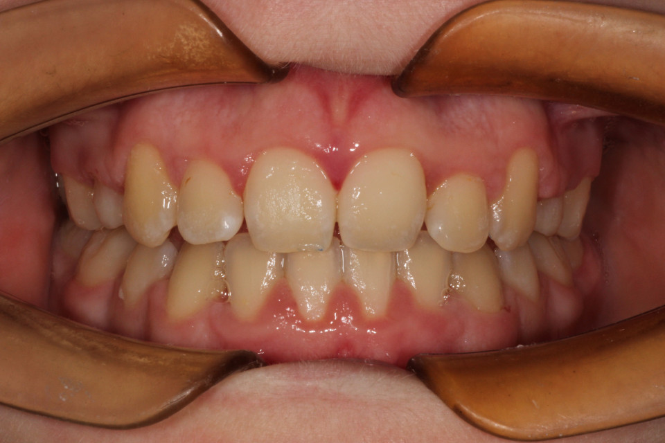 Ceramic Braces, Burnie  The Orthodontic Specialists, Devonport