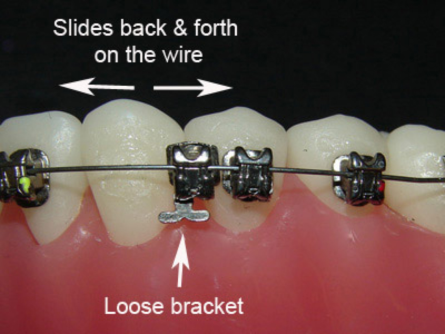 What Should I Do if My Braces Wire Came Out?