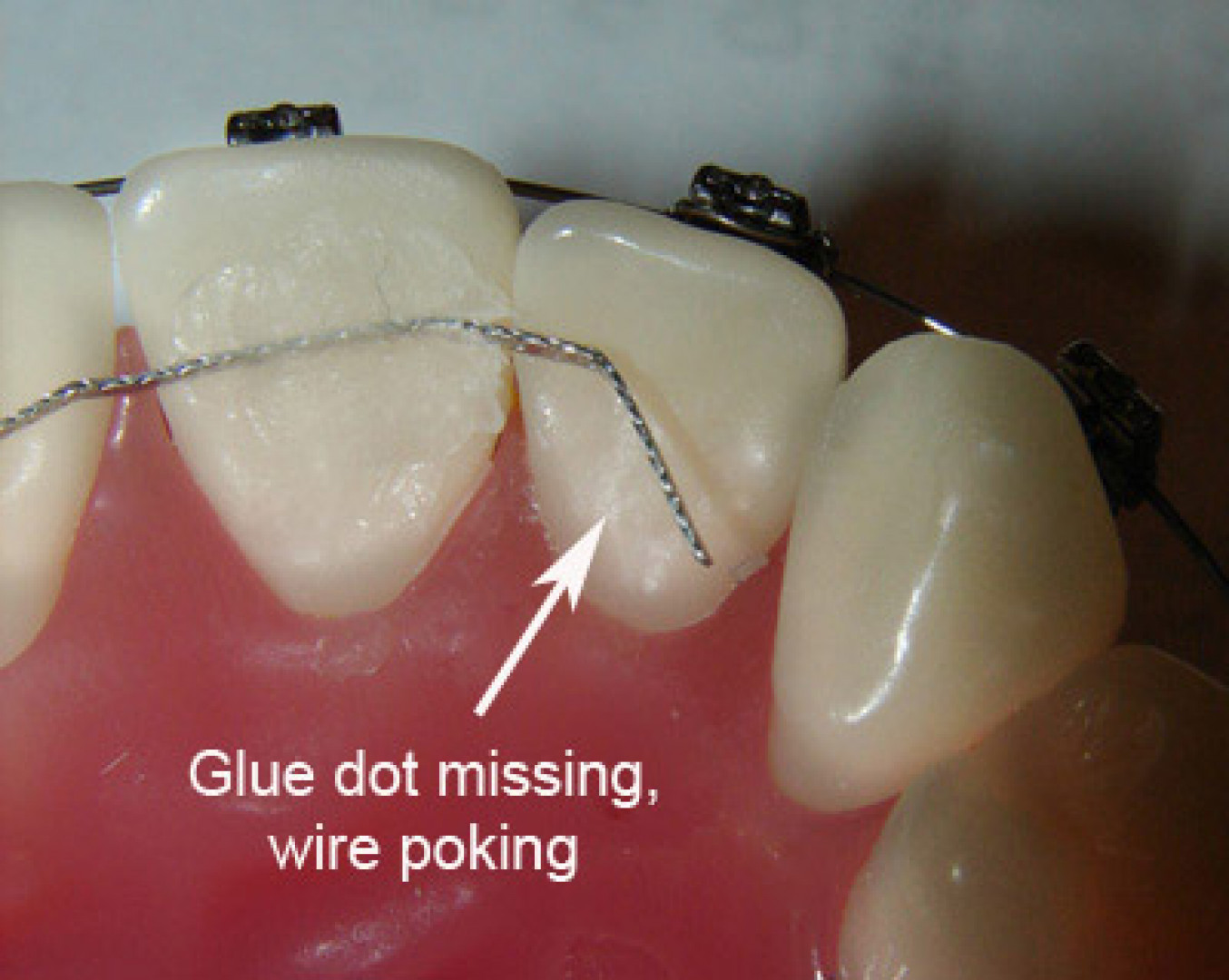 Wire poking out..quick solution before I can fix in on Monday : r/braces