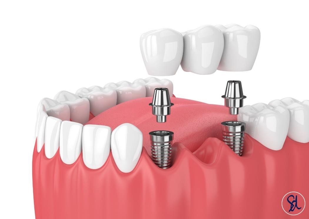 Implant retained bridge.