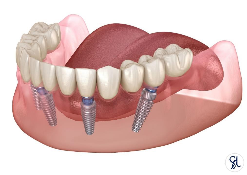 All-on-4 Implants