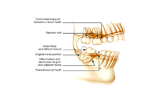 Missing Teeth Diagram