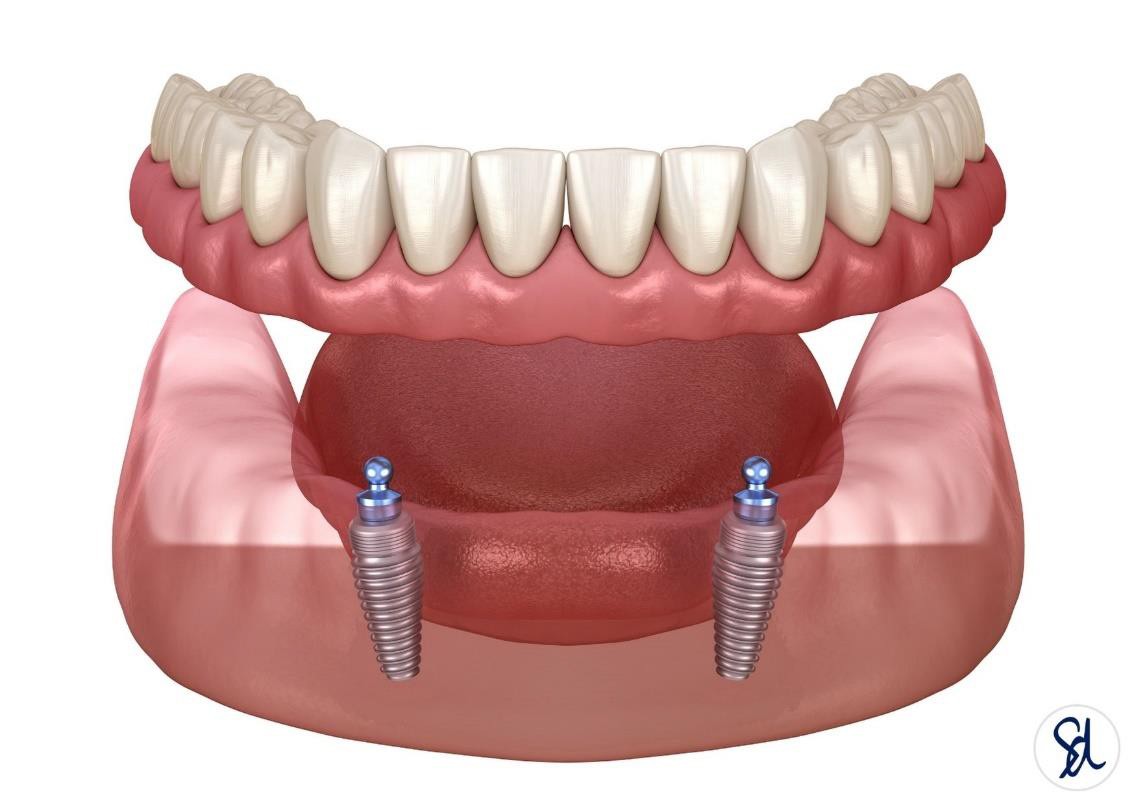 Implant retained dentures 