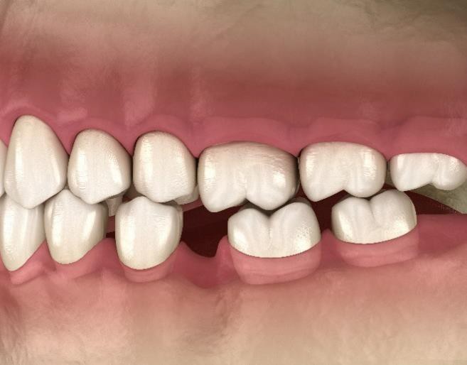 Why replace missing teeth?