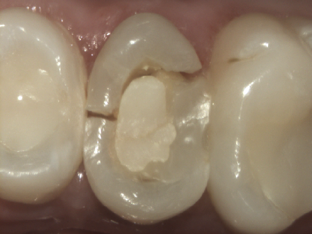 real root canal with filling example