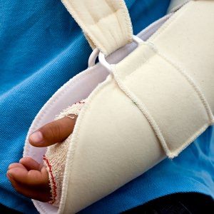 Fractured hand