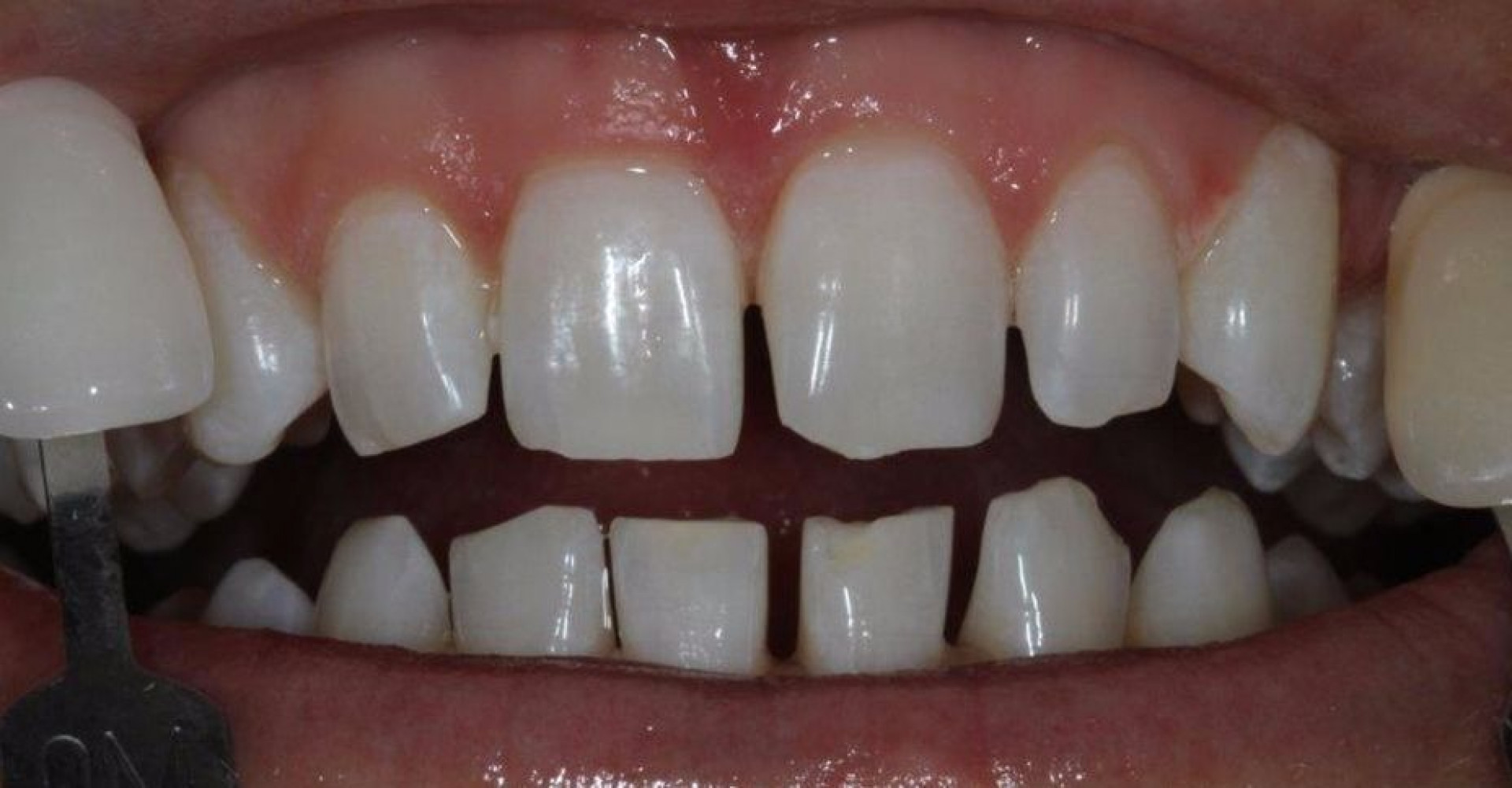 Does Bupa Health Insurance Cover Teeth Whitening - All information about covid