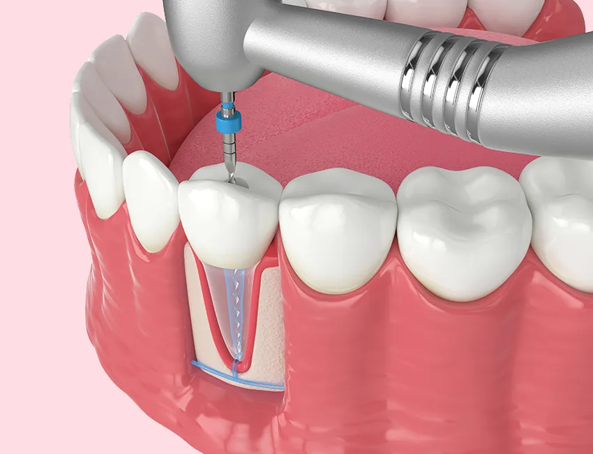 Endodontic Surgery/Apicoectomy