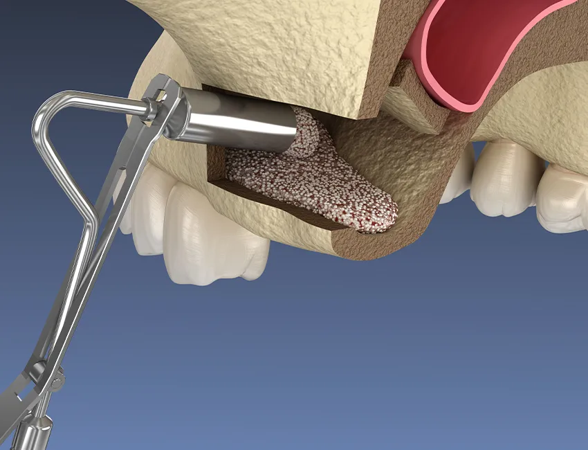 Sinus Lift