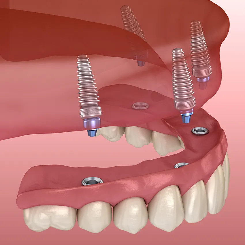All-on-4 dental implants model