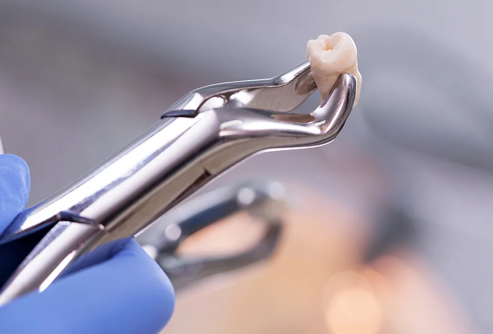 Tooth extraction