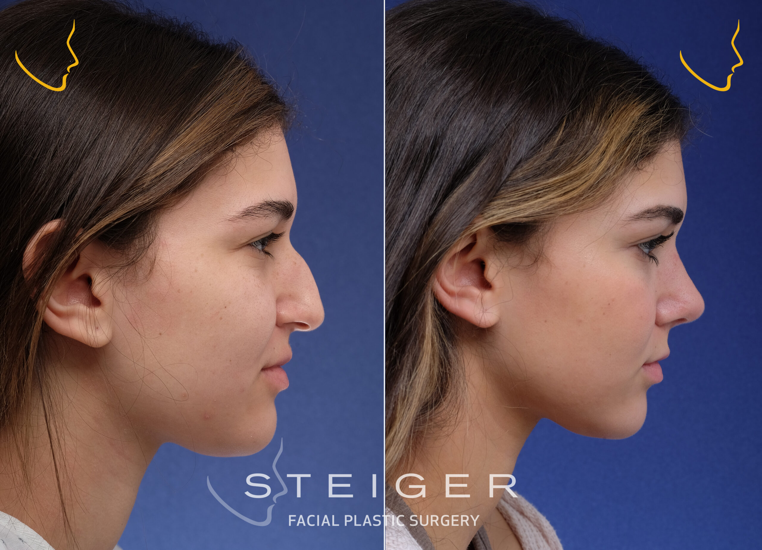 Professional rhinoplasty consultation