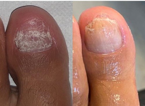 How to effectively use Lamisil when treating fungal nail infections. |  MyFootShop.com