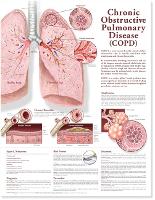 Book Cover for Chronic Obstructive Pulmonary Disease Anatomical Chart by Anatomical Chart Company