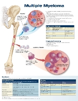 Book Cover for Multiple Myeloma Anatomical Chart by Anatomical Chart Company