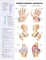 Book Cover for Understanding Arthritis Anatomical Chart by Anatomical Chart Company