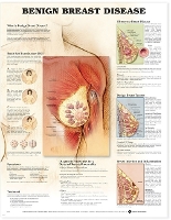 Book Cover for Benign Breast Disease Anatomical Chart by Anatomical Chart Company