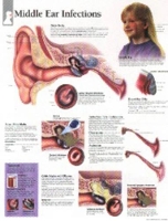 Book Cover for Middle Ear Infections Laminated Poster by Scientific Publishing