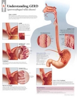 Book Cover for Understanding GERD (Gastroesophageal Reflux Disease) Laminated Poster by Scientific Publishing