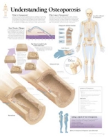 Book Cover for Understanding Osteoporosis Paper Poster by Scientific Publishing