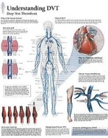 Book Cover for Understanding DVT Laminated Poster by Scientific Publishing