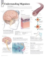 Book Cover for Understanding Migraines Laminated Poster by Scientific Publishing