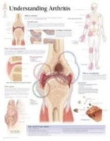 Book Cover for Understanding Arthritis Laminated Poster by Scientific Publishing