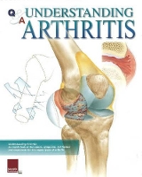 Book Cover for Understanding Arthritis Flip Chart by Scientific Publishing