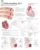 Book Cover for Understanding ACS (Acute Coronary Syndrome) Laminated Poster by Scientific Publishing