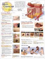 Book Cover for Understanding Skin Cancer Anatomical Chart by Anatomical Chart Company